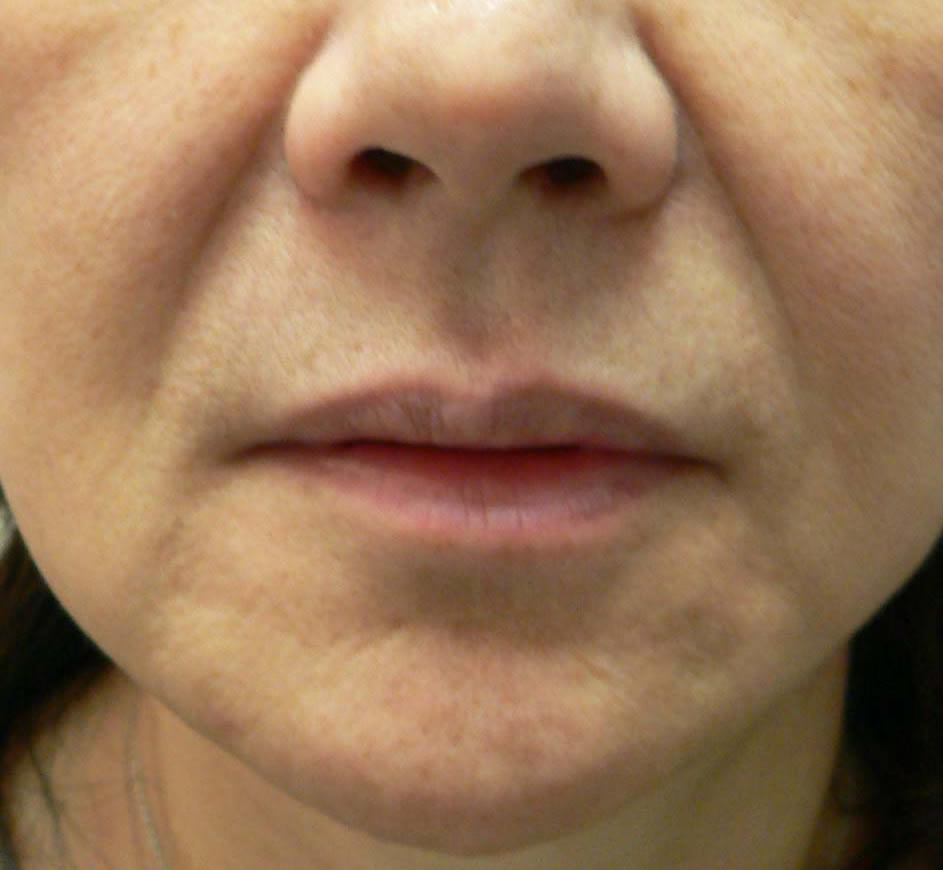 nasolabial smile line before midtown manhattan nyc